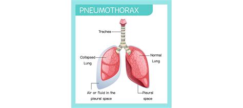 Tension Pneumothorax: Explanation, Causes, Signs, Symptoms, and Treatment | Learn from doctor