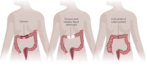 Treatments - Surgery - Digestive Cancers Europe