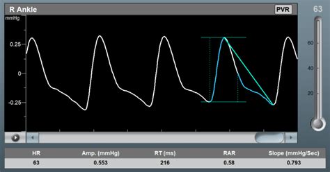 FAQ about Pulse Volume Recording (PVR)