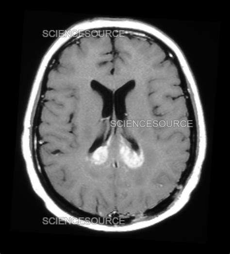 Photograph | MRI of Cerebral Lymphoma | Science Source Images