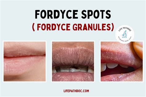 What Causes Fordyce Spots On Lips - Infoupdate.org