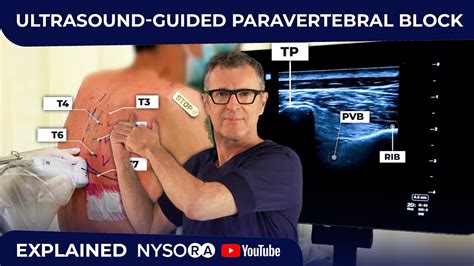 ULTRASOUND-GUIDED PARAVERTEBRAL BLOCK - YouTube