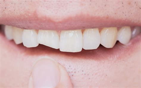 5 tips for Trauma to teeth or TMJ Medical Claims - Nierman Practice Management