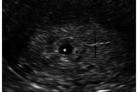 Ultrasound Image of an Early Intrauterine Pregnancy with the ...