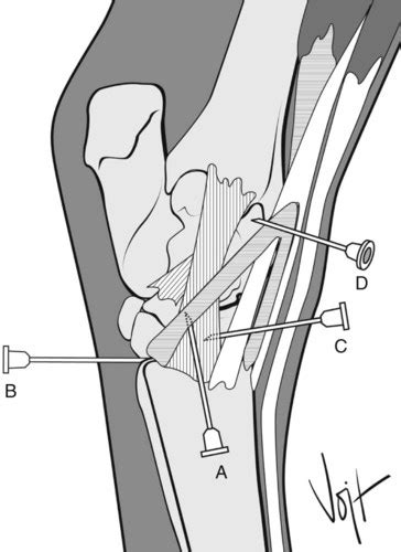 Local Anesthesia in Horses | Veterian Key