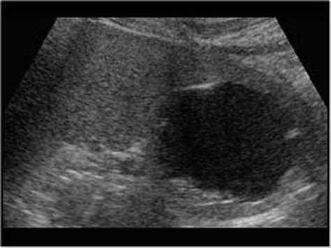 Abdomen and retroperitoneum | 1.4 Spleen : Case 1.4.1 Cysts and ...