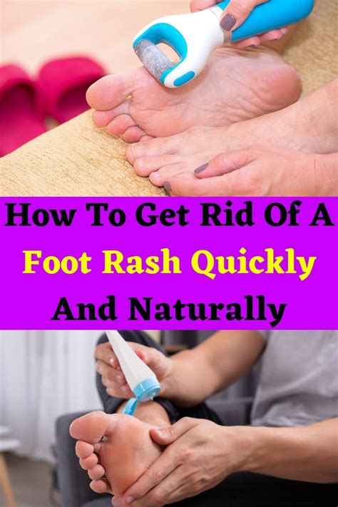 How To Get Rid Of A Foot Rash Quickly And Naturally in 2021 | Foot rash, Best skin care routine ...