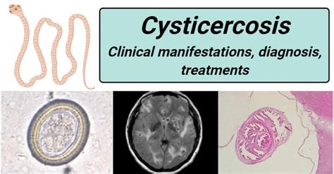 Cysticercosis- Clinical manifestations, diagnosis, treatment