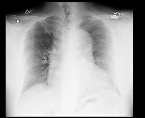 Aortic dissection chest x ray - wikidoc
