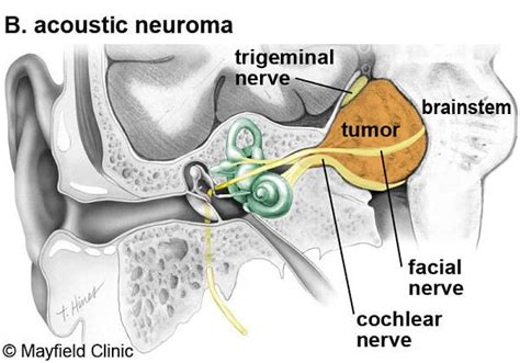 Image result for acoustic neuroma | Nervio facial, Nervio, Acústico