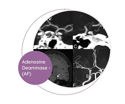 Adenosine Deaminase - (AF) - MediScan Lab