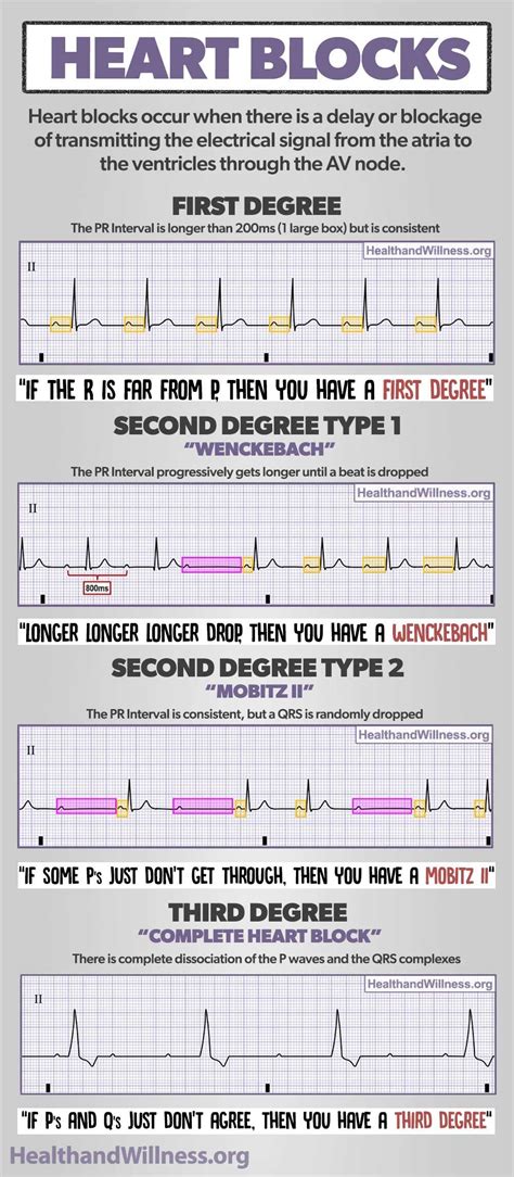 How to Read an EKG Rhythm Strip | Health And Willness | Emergency nursing, Heart blocks ...