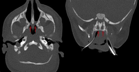 Choanal Atresia: aetiology, symptoms, signs, investigations and treatment