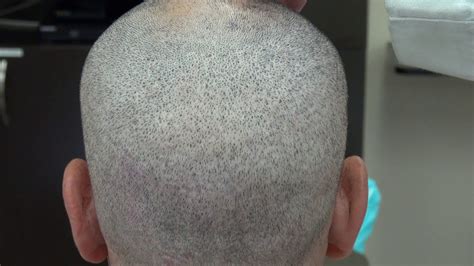 FUE Scar After 4 FUE Hair Transplant Surgeries Follicular Unit Extraction Minimal Scars - YouTube