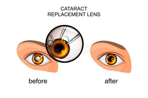 Replacement of the Crystalline Lens in Cataract Stock Vector - Illustration of oculist, care ...