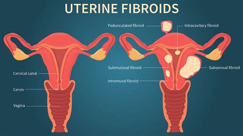 Il collegamento tra fibromi uterini e sanguinamento mestruale pesante ...