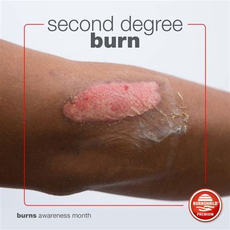 What is the Difference between a Superficial / First-degree burn and a Partial-thickness or ...