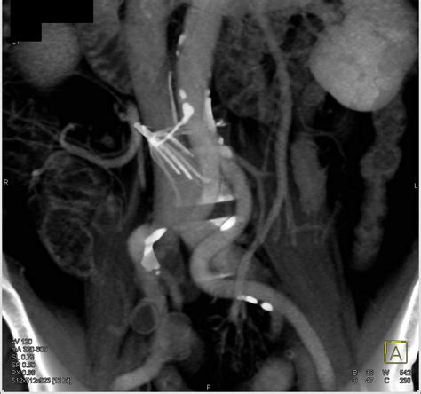 Malpositioned IVC Filter - Vascular Case Studies - CTisus CT Scanning