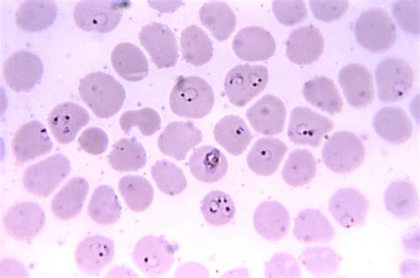 Plasmodium Falciparum Labeled