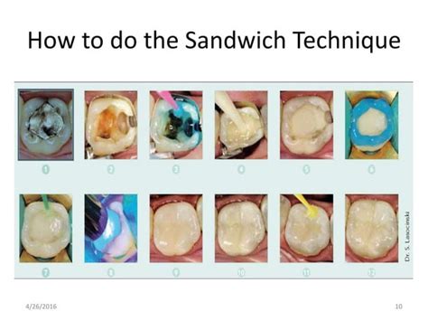 Sandwich technique | PPT