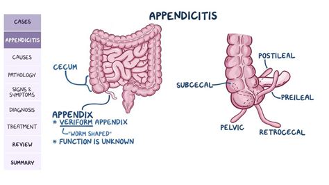 Appendicitis: Pathology review - Osmosis