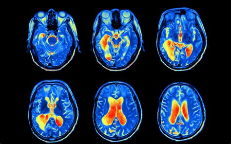 Neuroscience | UCL Research Domains - UCL – University College London