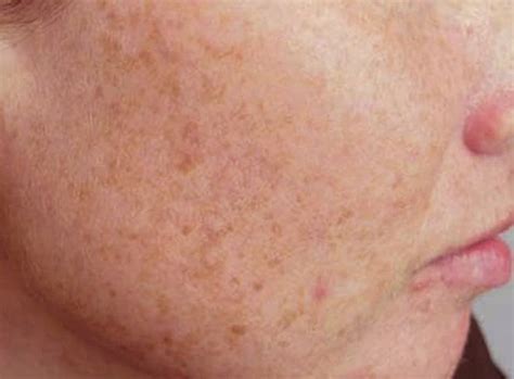 Liver Spots: Causes, Treatments, and Removal Options - YouMeMindBody