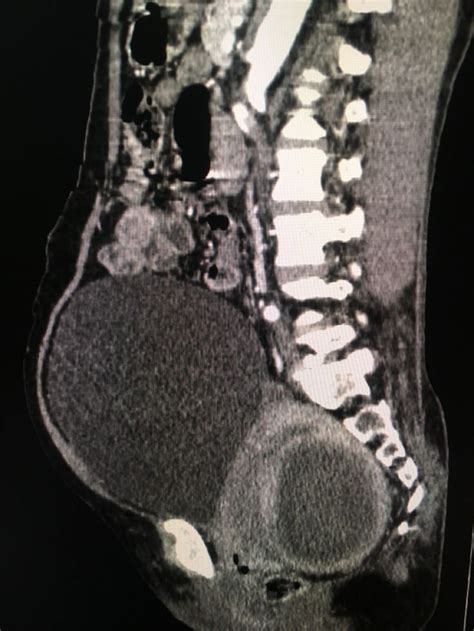 Subserosal fibroid with cystic degeneration