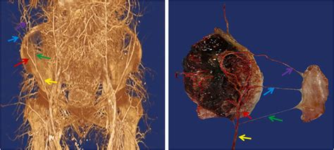 Variations in deep iliac circumflex artery perforator chimeric flap design for single-stage ...