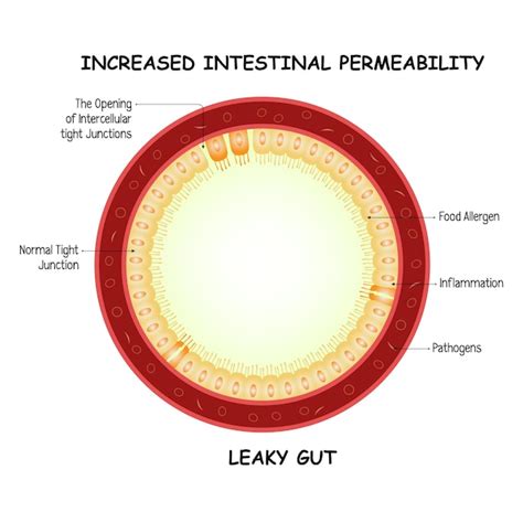 Premium Vector | Increased Intestinal Permeability