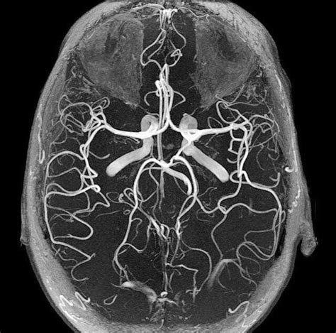 Circle Of Willis Mri Labeled