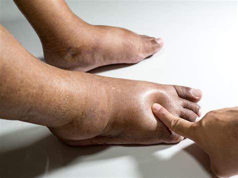 Diabetic Foot Pain: Here's What To Know | Canyon Oaks Foot & Ankle