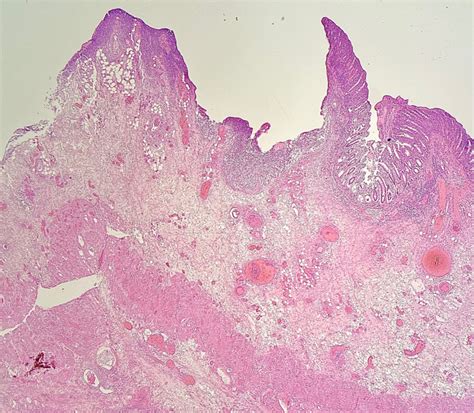 A low power (4× magnification) view showing a colonic ulcer forming an ...