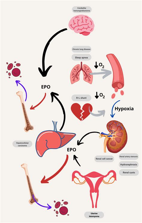 Polycythemia/Erythrocytosis - Differential Diagnosis • The Blood Project