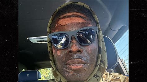 Browns' David Njoku Reveals Burned Face After Fire Pit Accident