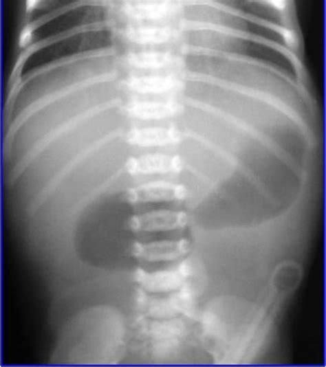 Duodenal Atresia (Double Bubble Sign on X-Ray) - radRounds Radiology Network