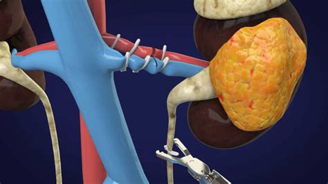 Laparoscopic Radical Nephrectomy – MKM Hospital