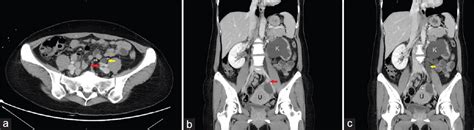 Periureteral Liposarcoma Causes of Hydroureter and Hydroneph... : Gynecology and Minimally ...