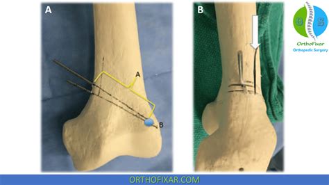 Distal Femoral Osteotomy | OrthoFixar 2024