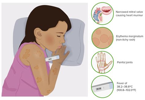 Fiebre Reumática | Concise Medical Knowledge