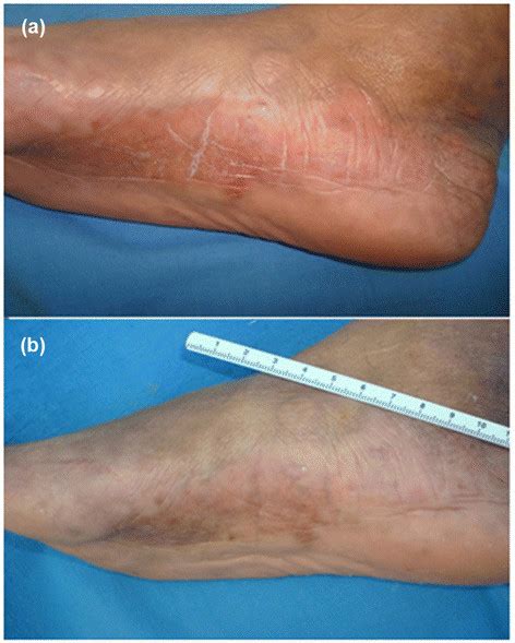 Early Scleroderma Skin Rash