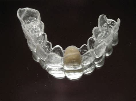 Clear Essix Pontic Retainer – Digital Dental Prosthetics