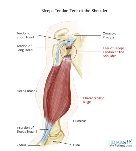 Biceps Tendon Tear at the Shoulder | Rehab My Patient