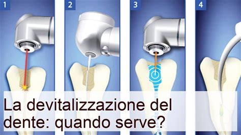 La devitalizzazione del dente: quando serve? - YouTube