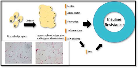 Type 2 diabetes mellitus and obesity, what is the link?