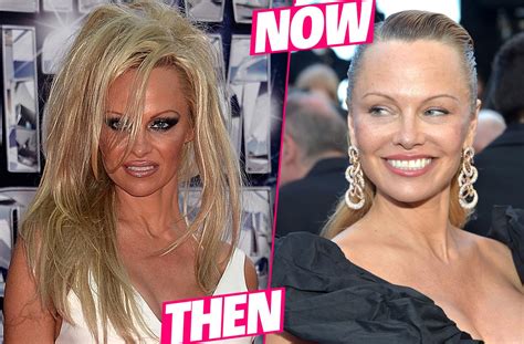 Pamela Anderson's Plastic Surgery Makeover Exposed By Top Docs