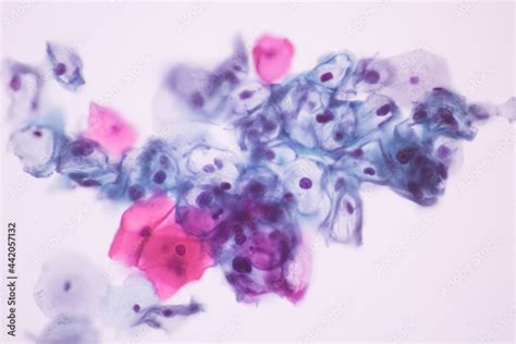 View in microscopic of koilocyte cell criteria of HPV (Human Papilloma virus) infection.Pap ...