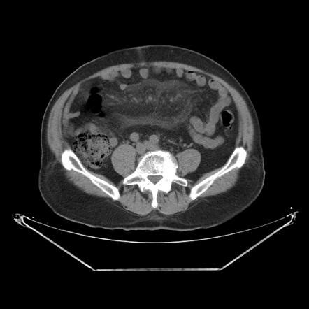 Sclerosing mesenteritis | Radiology Reference Article | Radiopaedia.org