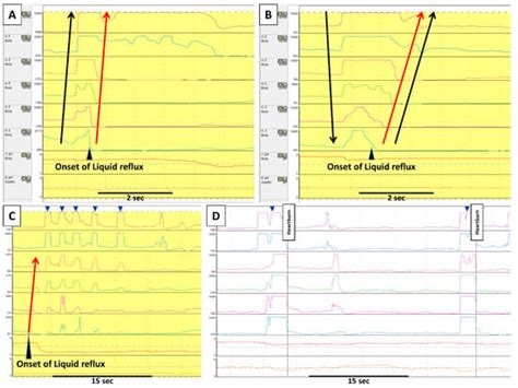 Belching | Encyclopedia MDPI