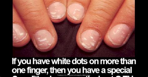 What Causes White Spots On Fingernails